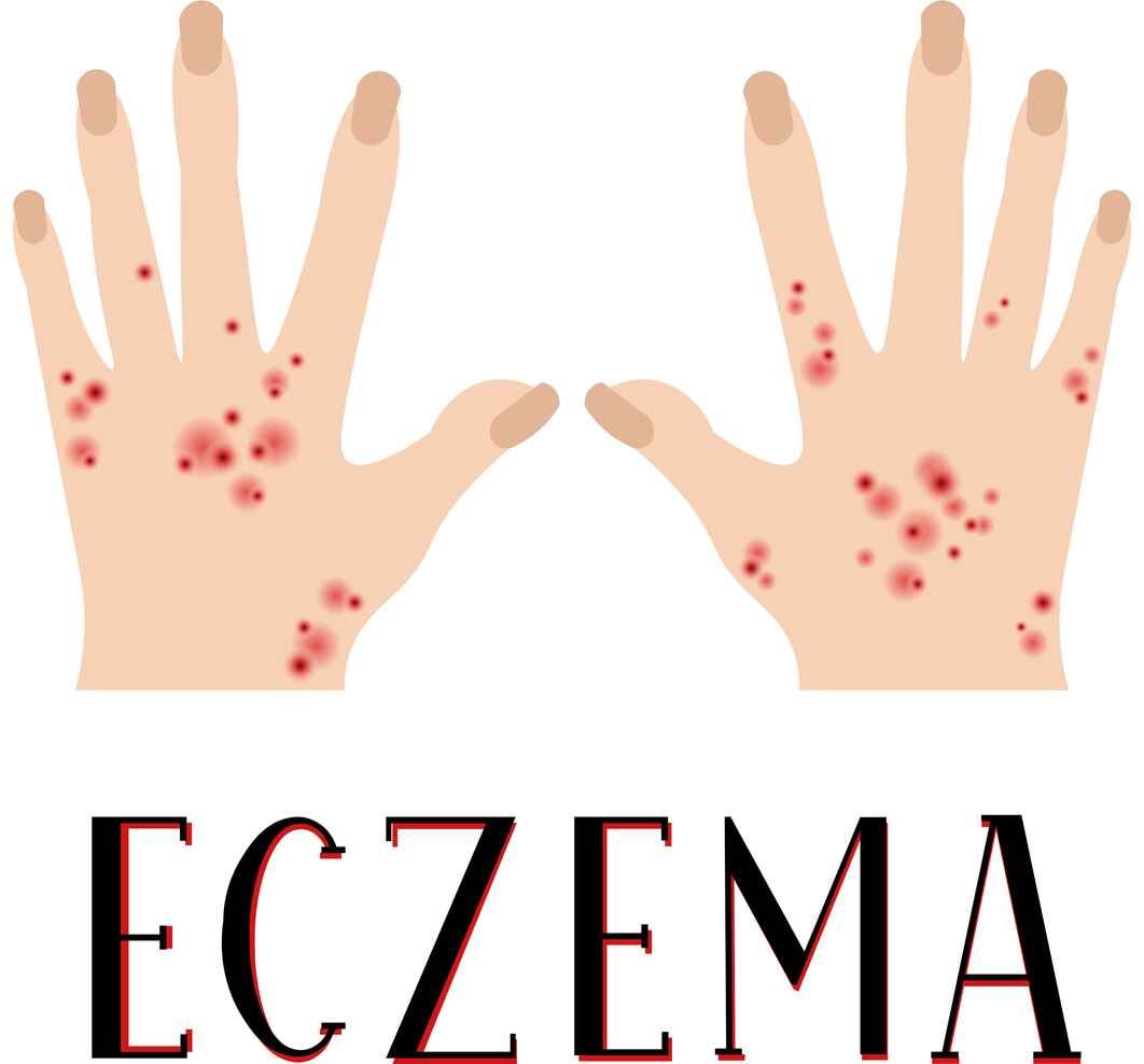 Symptoms and Causes Of Eczema Your Complete Guide